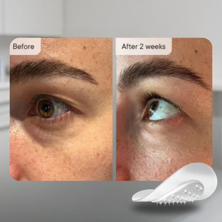 Serum Infused Microneedle Patches